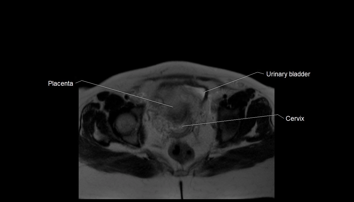 MRI fetal anatomy axial image 37.webp